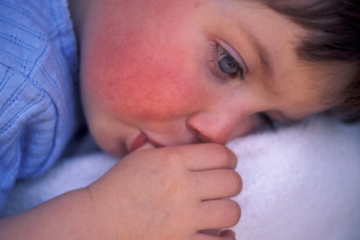 Температура у ребенка после прививки полиомиелит